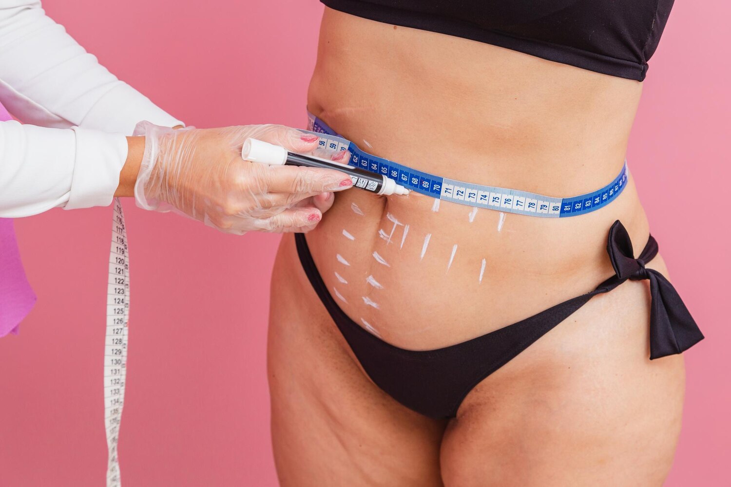 closeup photo performing measurements patient s abdomen performing aesthetic procedure 579344 889